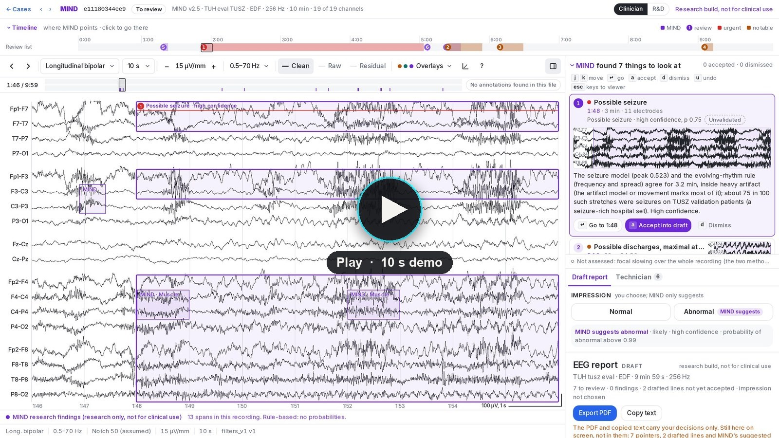 Screen recording of MIND listing seven things to look at, a possible seizure accepted, and a suggested impression